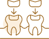 詰め物・被せ物